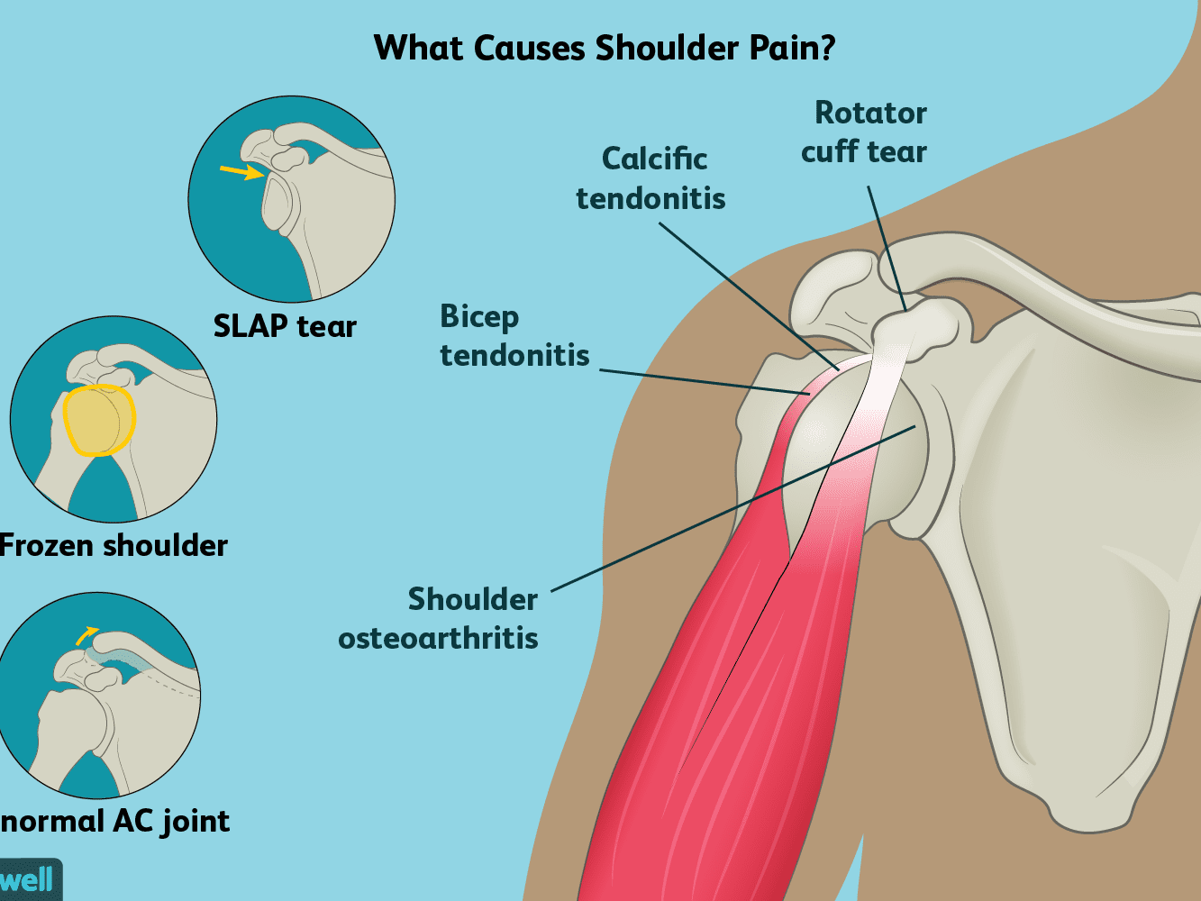 Shoulder Pain - Symptoms and Causes