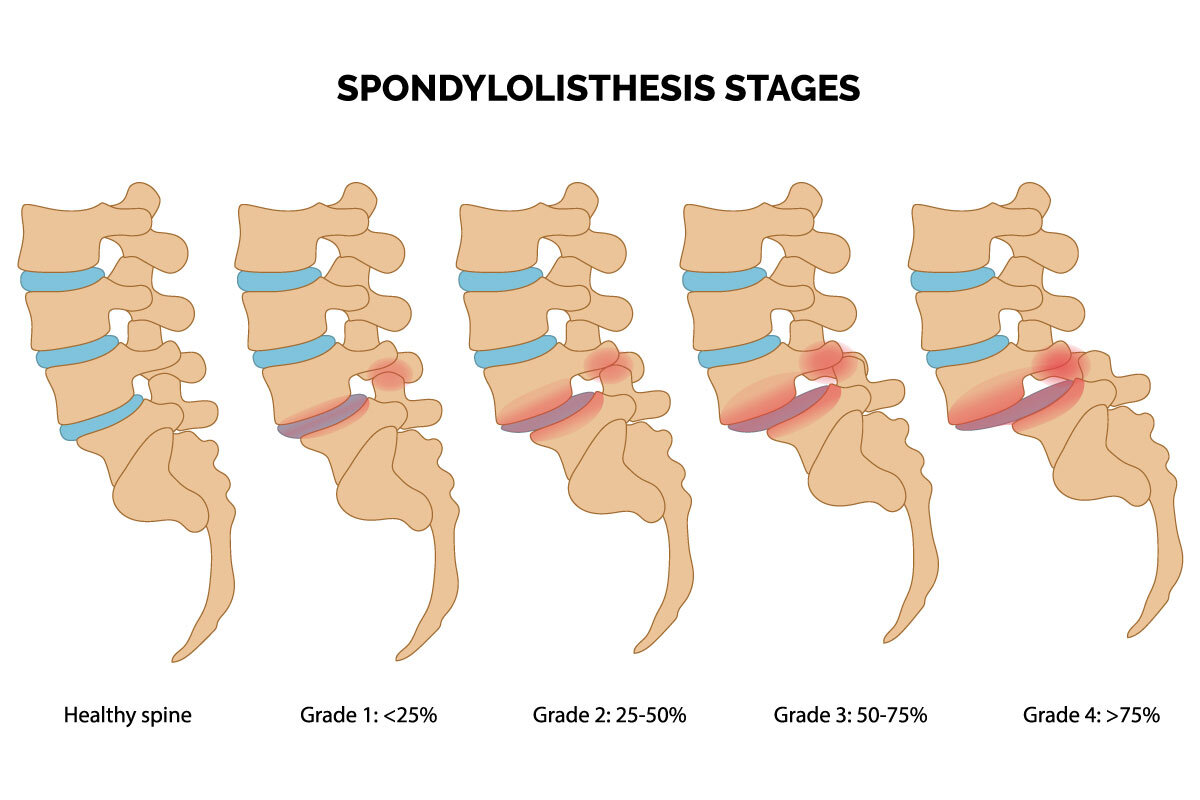 Spondylolisthesis