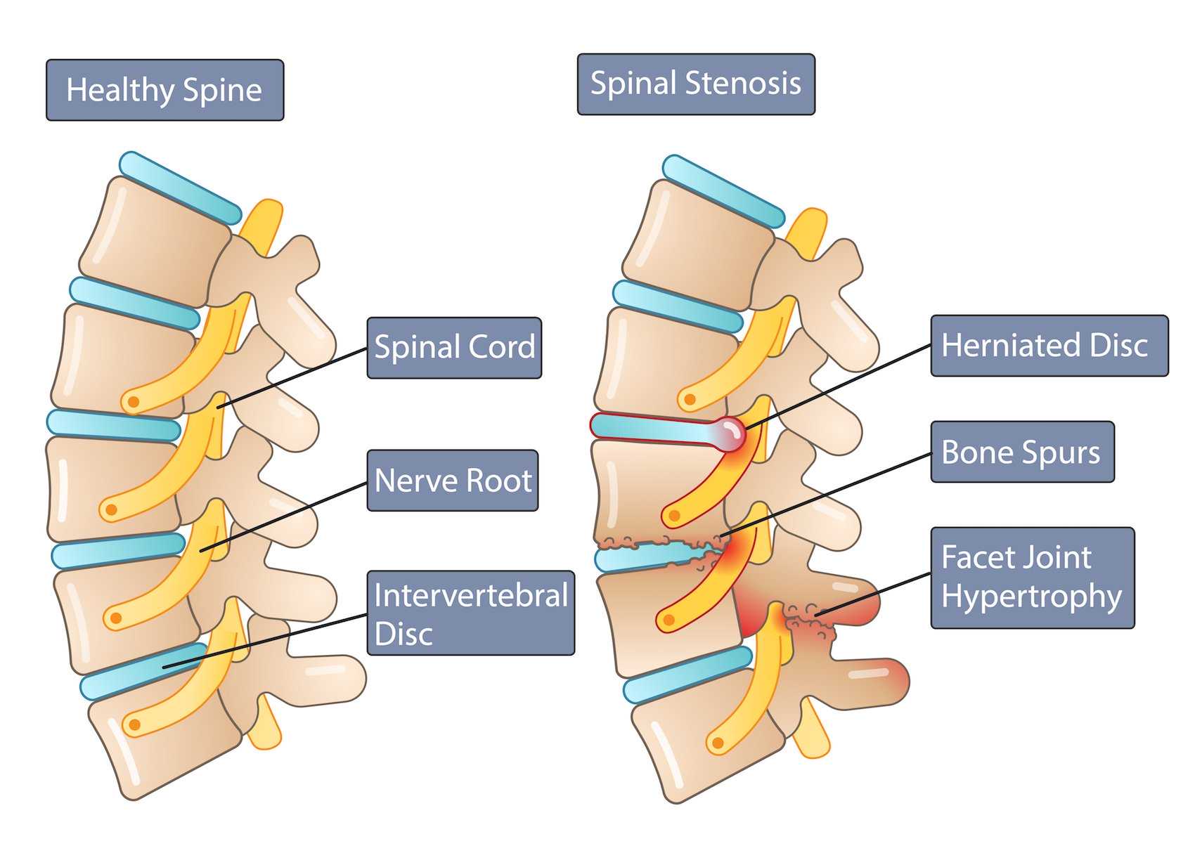 Have you been diagnosed with spinal stenosis but the prescribed treatment isn’t helping?