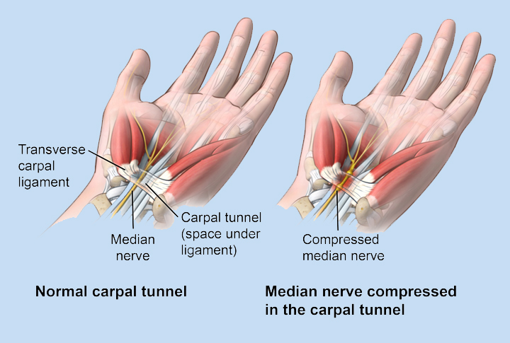 Carpal Tunnel Syndrome - Hands On Physical Therapy