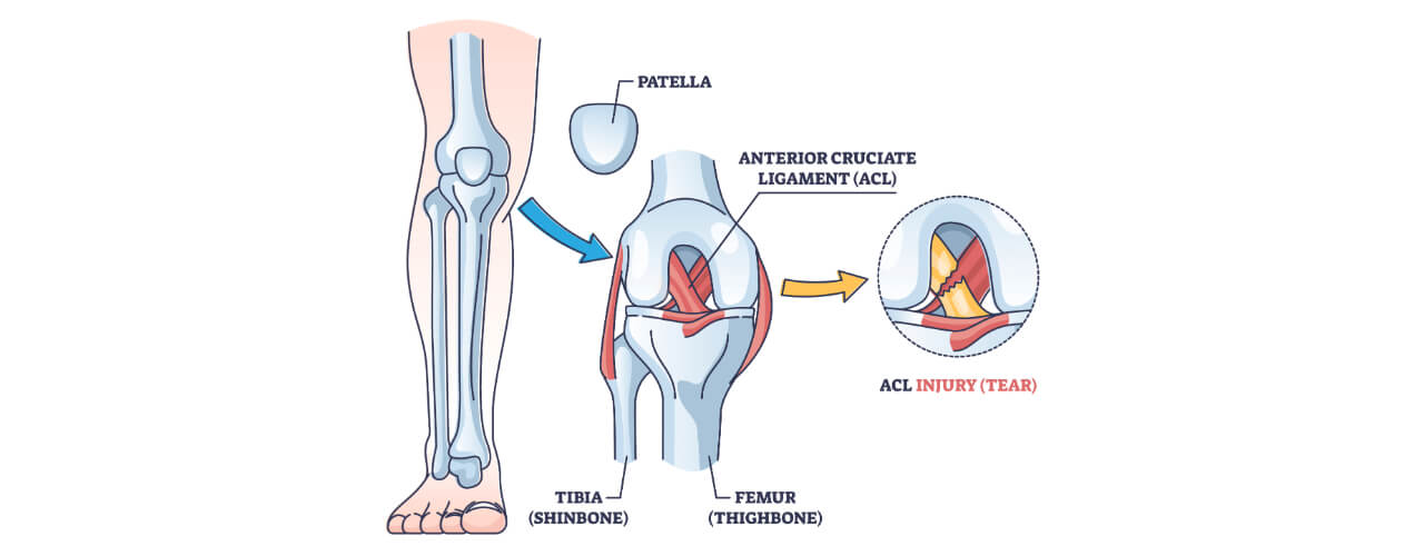 Overcoming Common ACL Reconstruction Rehab Challenges