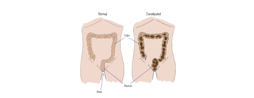 Fascia and constipation